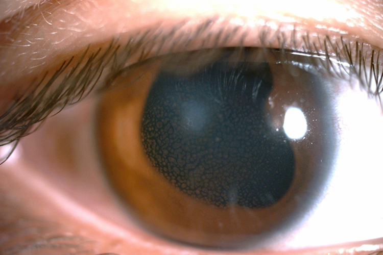 虹膜炎瞳孔粘连图片