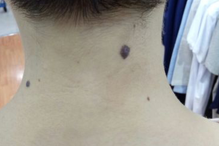 脖子黑色素瘤图 脖子黑色素瘤图