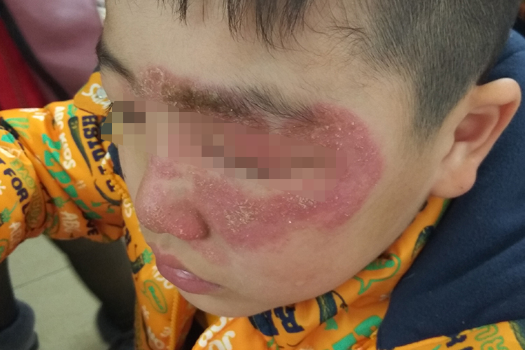 面部难辨认癣图