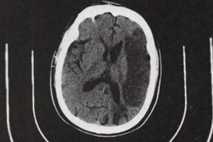 心源性大面积脑梗图