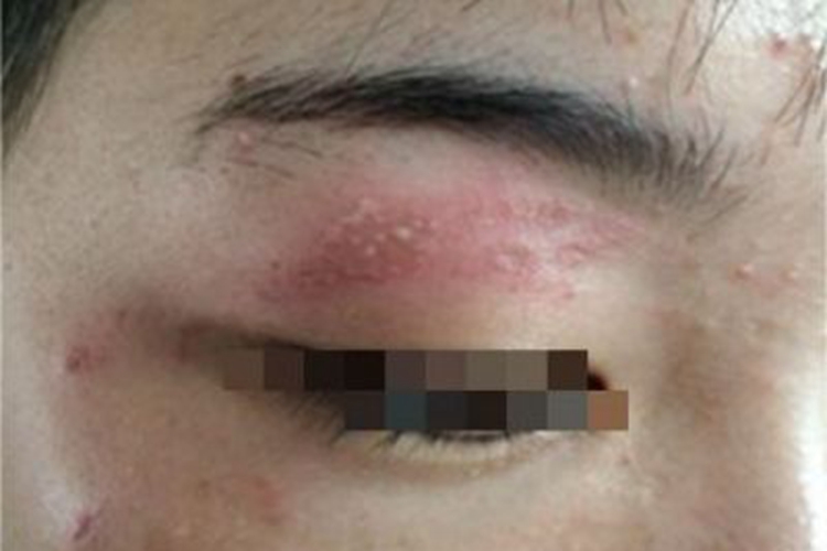 单纯疱疹病毒性睑皮炎眼皮发红图