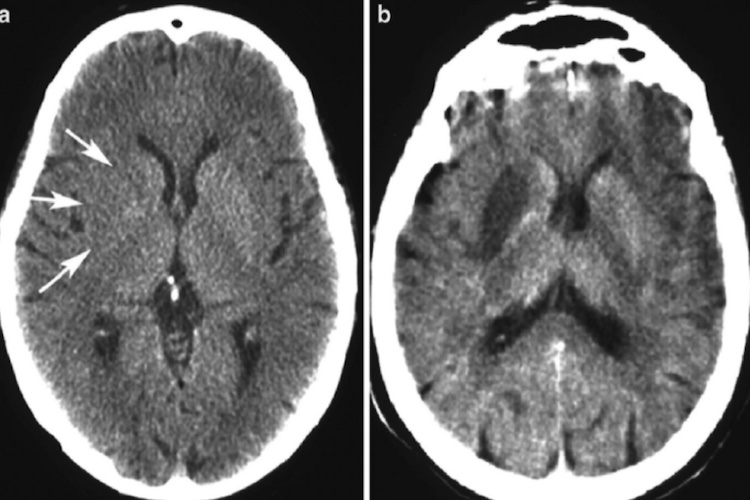缺血性梗死CT图