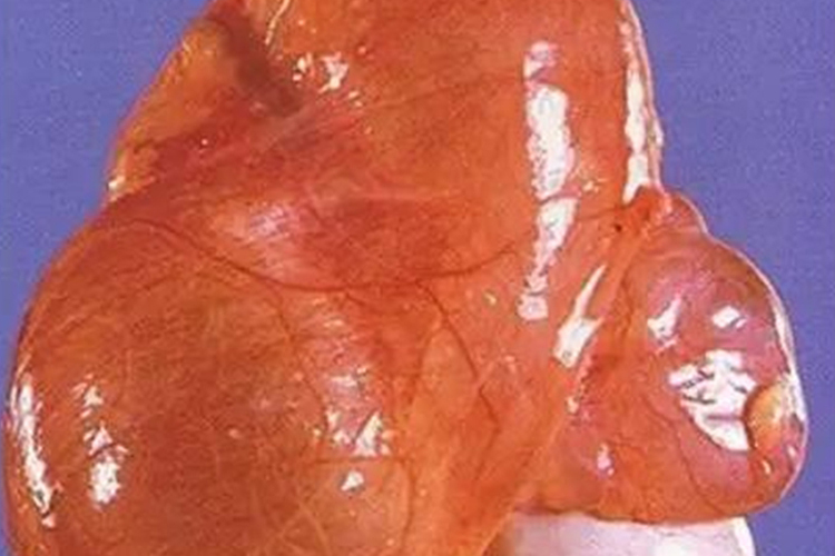 摘除的精液囊肿图