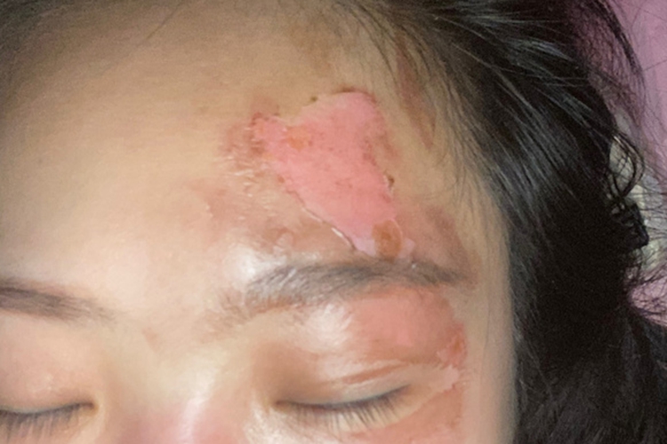 一度烧伤脸部图