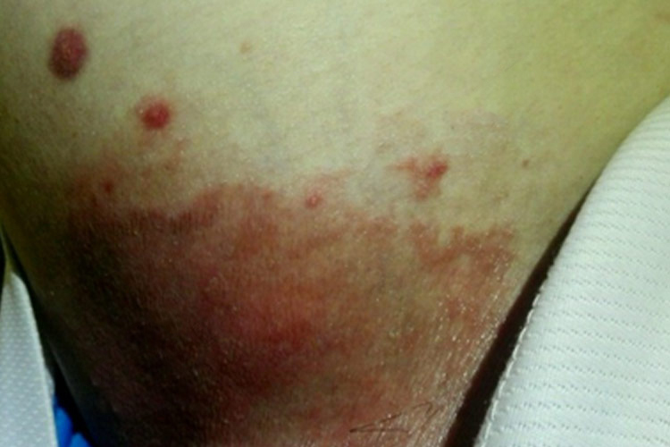 女性大腿根部亚急性湿疹图