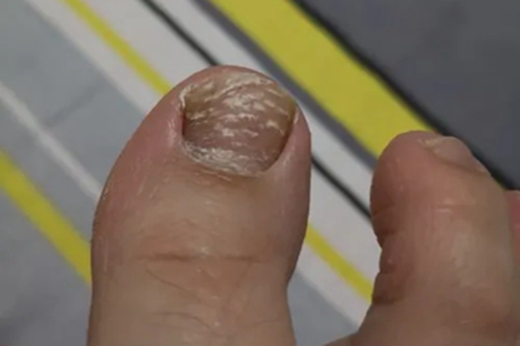 甲营养不良脚趾甲白点图