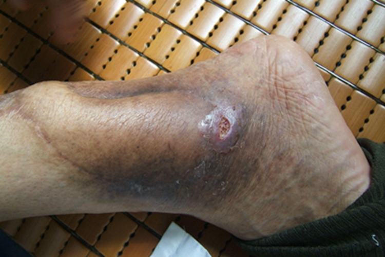 皮肤小血管炎脚踝溃疡皮肤发黑图