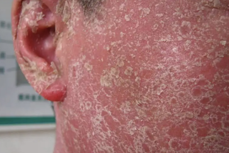 红皮病型银屑病晚期图