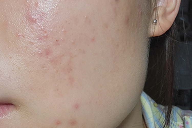 痤疮脸上有少量小疙瘩图