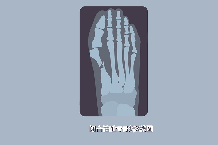 闭合性趾骨骨折X线图