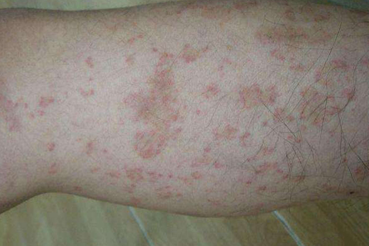 腿部毛细血管环状紫癜图