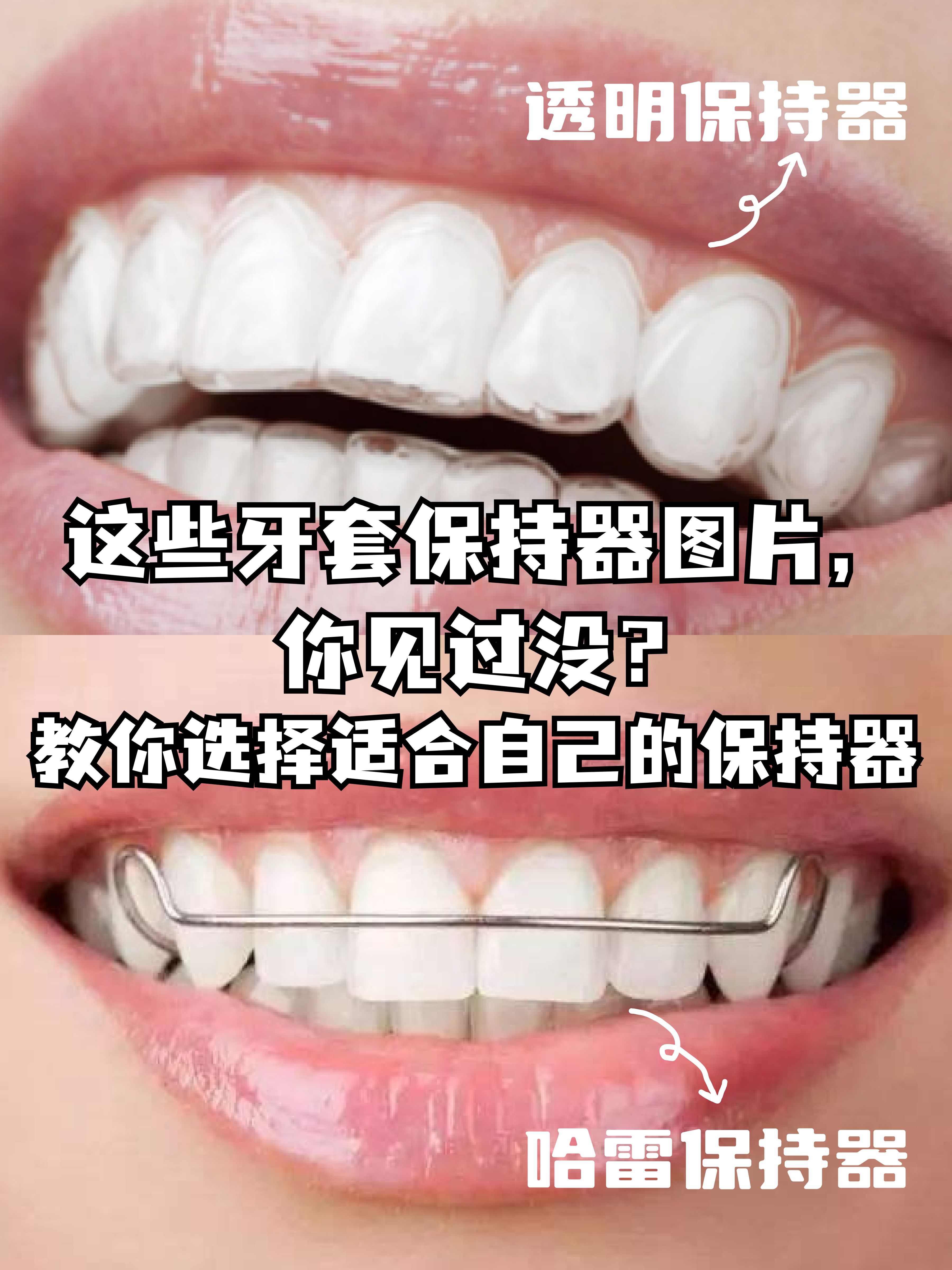 这些牙套保持器图片，你见过没？教你选择适合自己的保持器