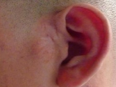 腮腺皮样囊肿耳前有一个肿块图.jpg