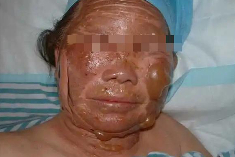 脸部深Ⅱ度烧伤图 脸部深Ⅱ度烧伤图