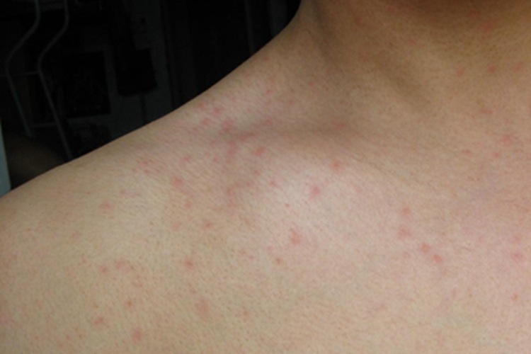 地方性斑疹伤寒肩部丘疹图
