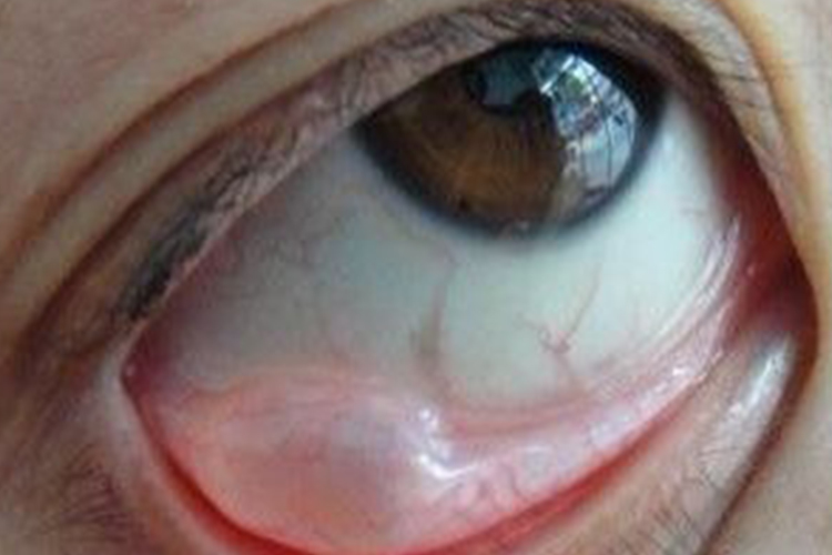 结膜炎眼尾发炎红肿图 结膜炎眼尾发炎红肿图