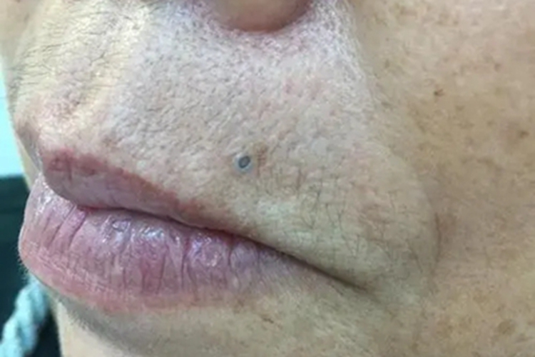 扩张孔口周症状图