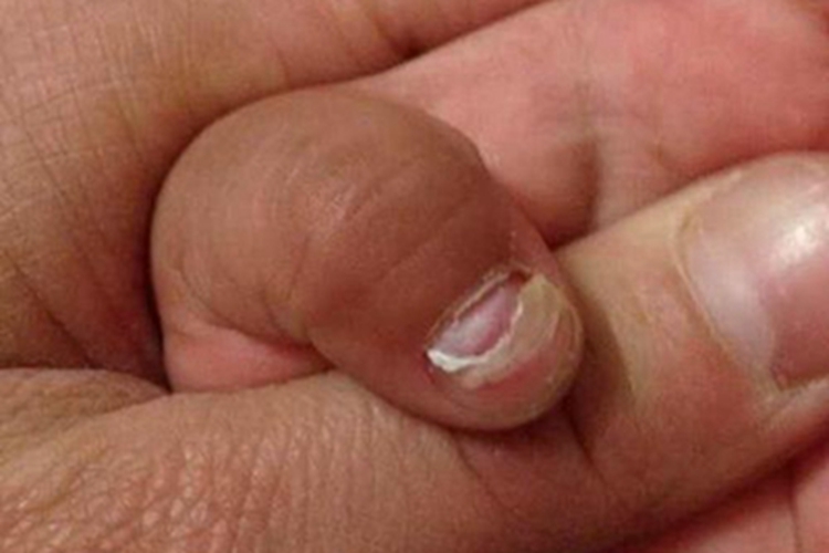 脱甲病手指甲变形图