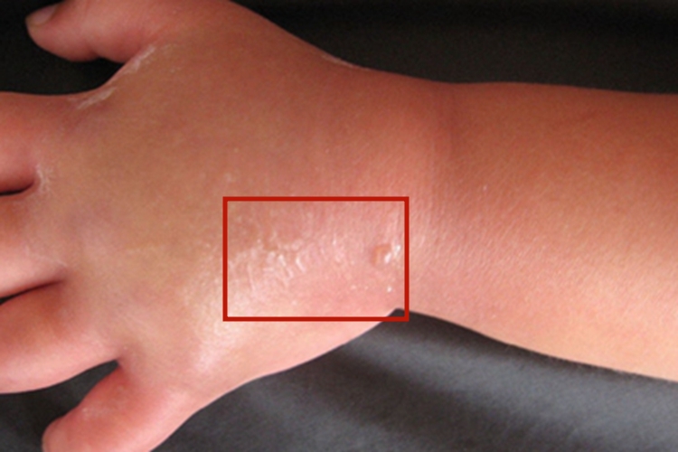 蜂蛰伤手背有小水疱图