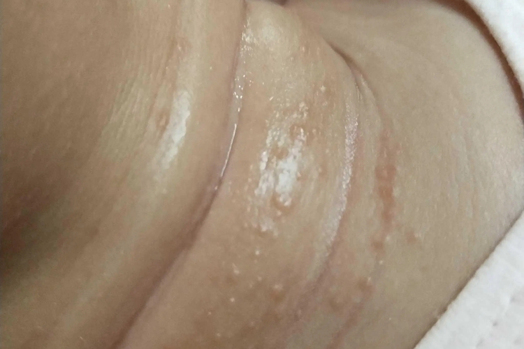 婴儿脖子白痱图