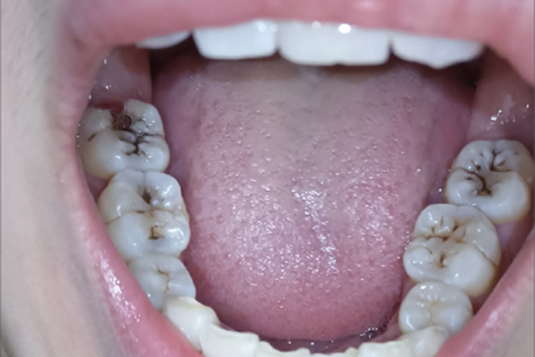 中龋牙齿发黑烂了图