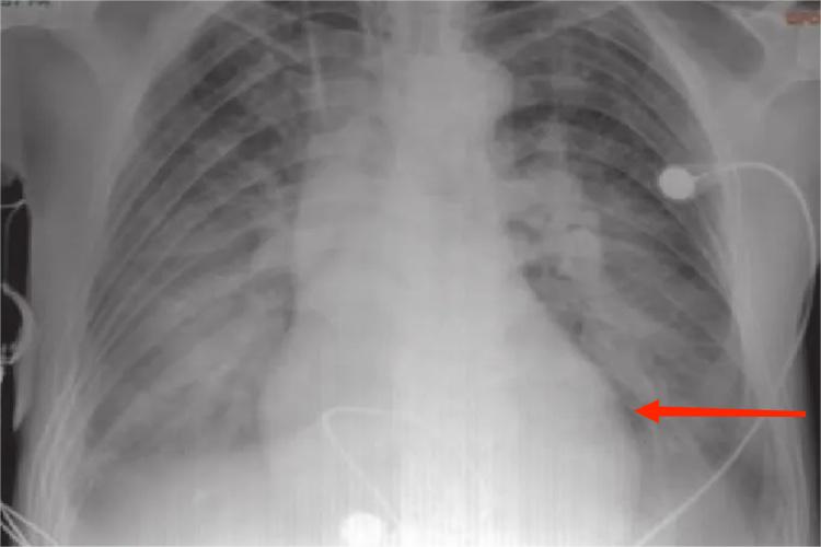 心肌炎胸部X线检查图 心肌炎胸部X线检查图