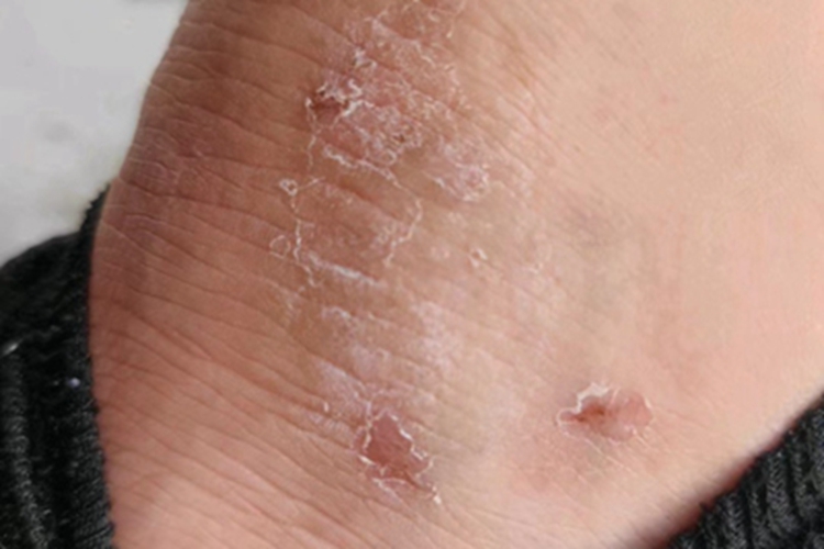 慢性湿疹脚踝脱皮发白图 慢性湿疹脚踝脱皮发白图