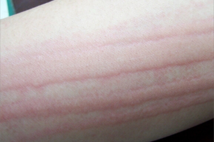 人工荨麻疹条纹图 人工荨麻疹条纹图