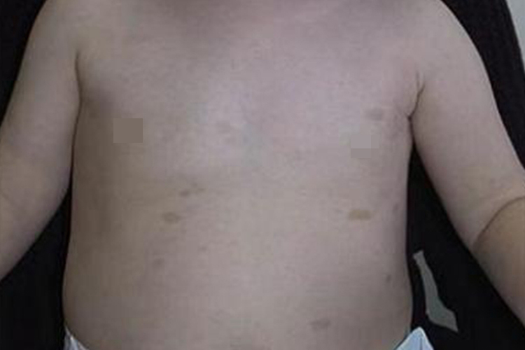 咖啡斑的初期症状图