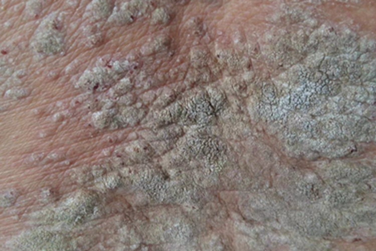 慢性湿疹背部症状图