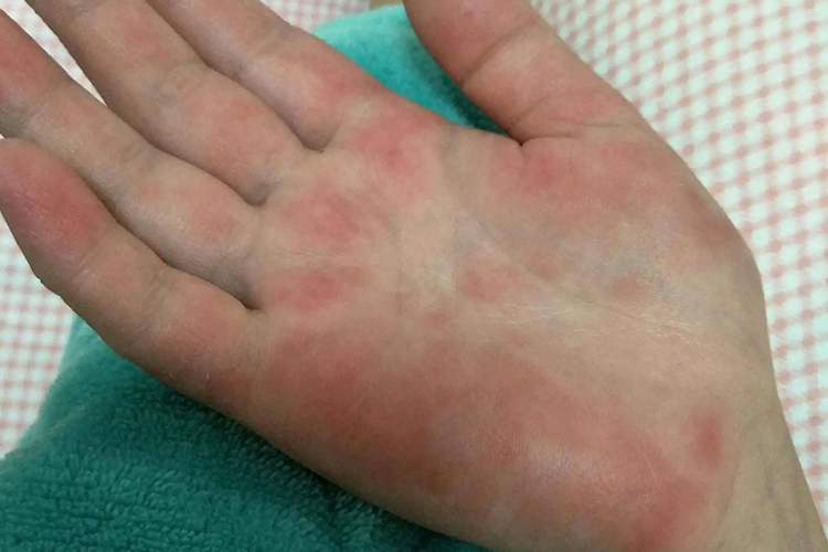 手掌皮肤小血管炎图