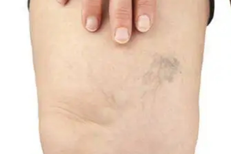 下肢深静脉血栓大腿水肿图