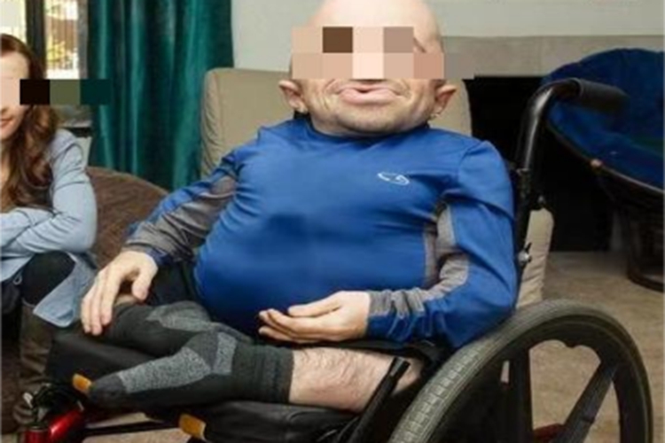 侏儒症全身症状图