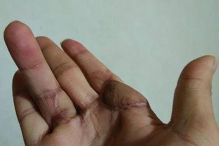 掌腱膜挛缩症手部结节图
