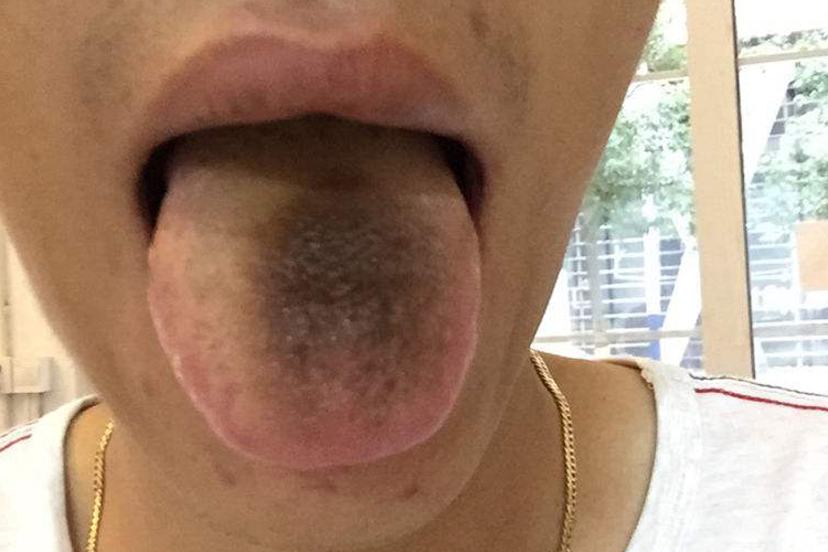 吃中药舌头变黑图 吃中药舌头变黑图