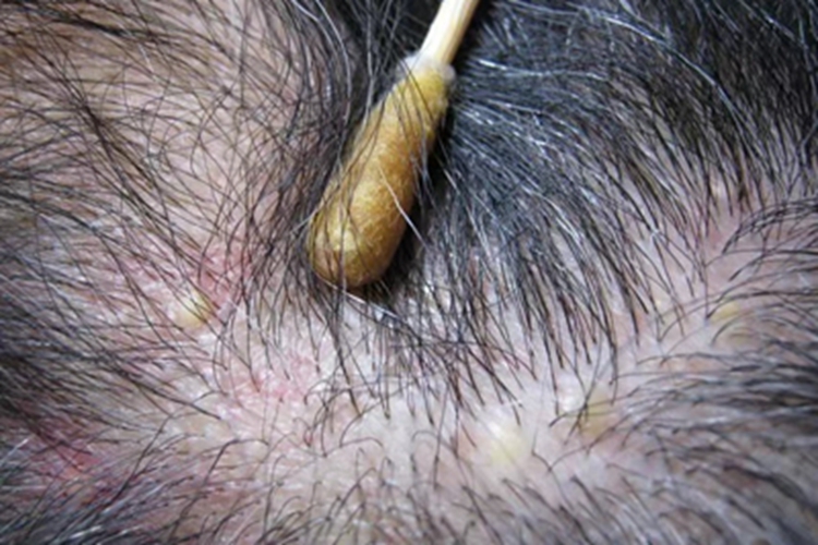 毛囊炎头皮上黄色脓包图 毛囊炎头皮上黄色脓包图