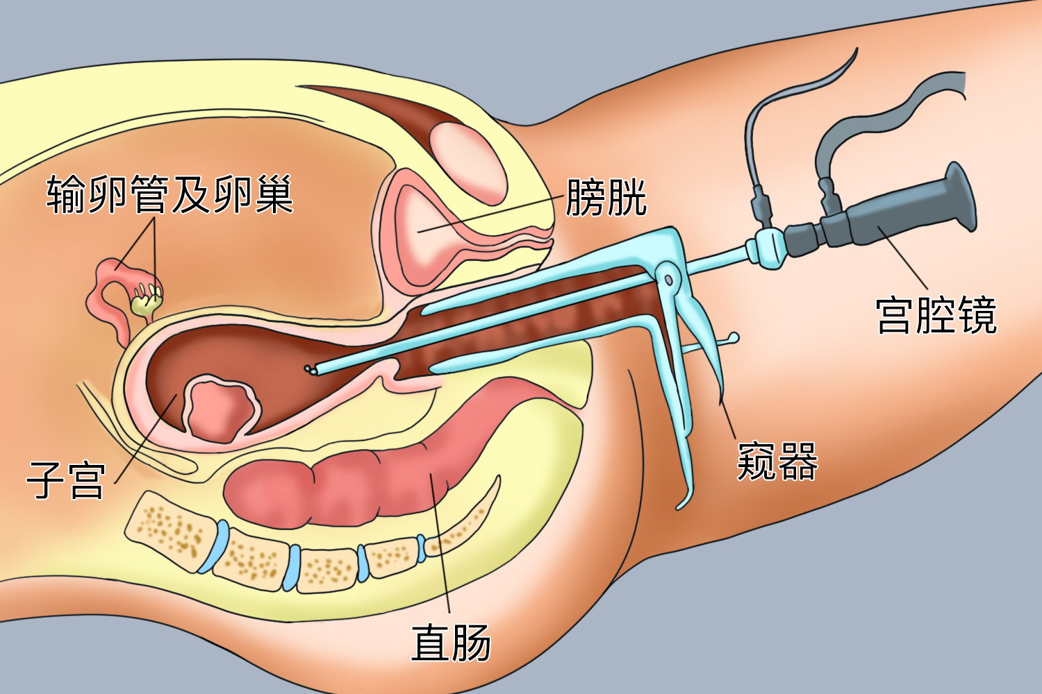 宫腔镜手术示意图