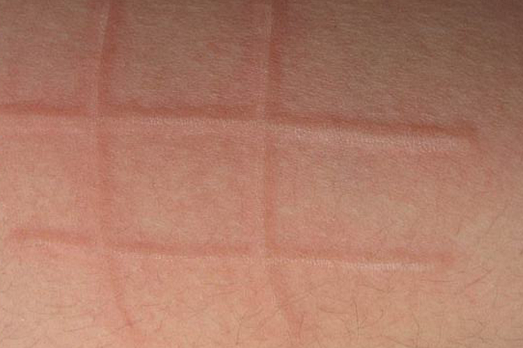 诱导性荨麻疹图