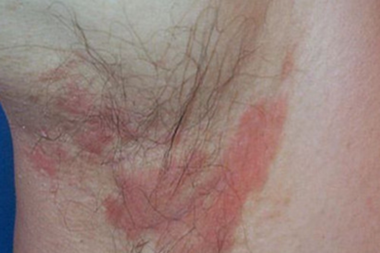 脂溢性皮炎腋窝症状图