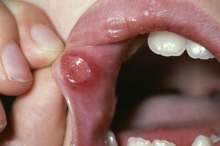 口腔上颚黏膜溃疡图片图片