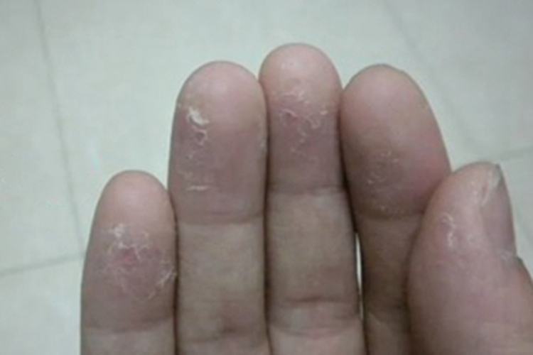 疣状红斑狼疮手指症状图