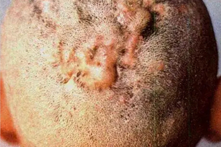 秃发性毛囊炎软疙瘩图 秃发性毛囊炎软疙瘩图