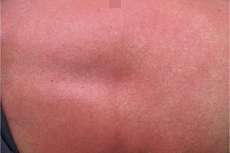 碘疹胸部大片发红图