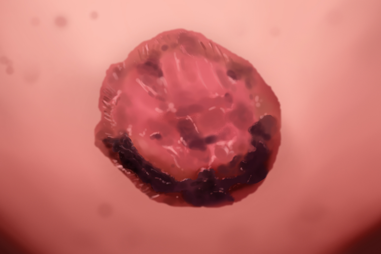 乳腺癌乳头表皮坏死图