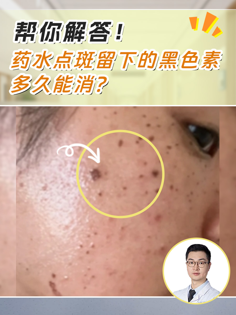 帮你解答！药水点斑留下的黑色素多久能消？
