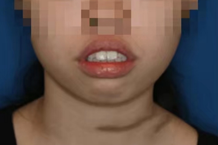 牙齿矫正前面容图