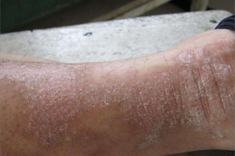 淤积性皮炎脚踝症状图 淤积性皮炎脚踝症状图