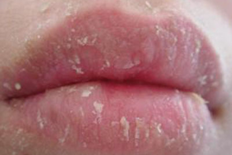 婴儿嘴唇皲裂脱屑图 婴儿嘴唇皲裂脱屑图