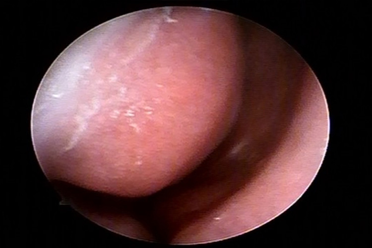 鼻甲肥大鼻黏膜有肿块图