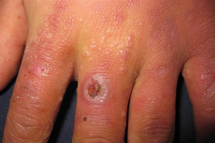 寒冷性多形红斑手背水疱图